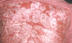 糜烂性脓疱型银屑病的发病特征