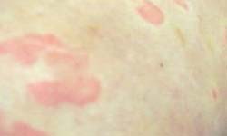慢性荨麻疹的症状有什么