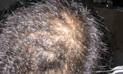 脂溢性脱发的症状表现