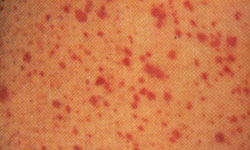 青霉素发生皮肤过敏怎么办