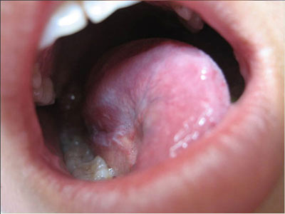 扁平苔藓对口腔的损害