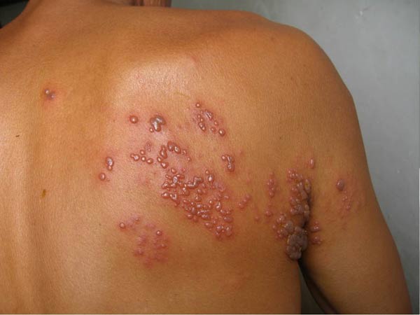 带状疱疹会导致什么危害