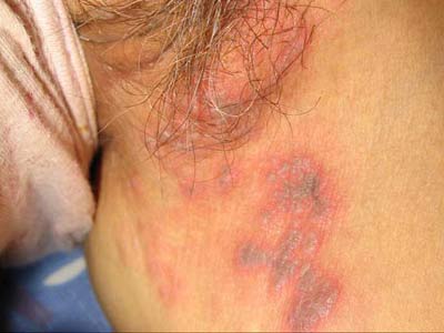 带状疱疹能预防吗
