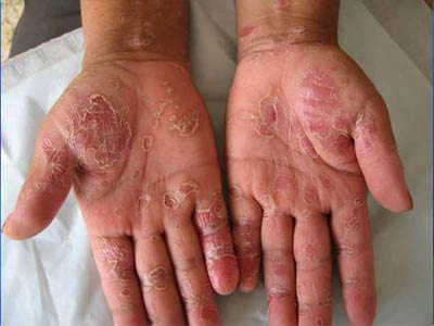 银屑病的进行期皮肤损害特点
