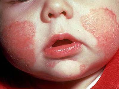 小孩面部湿疹如何治疗