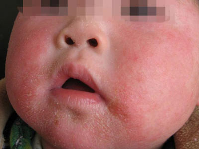 小儿发生婴儿湿疹会有哪些症状发生