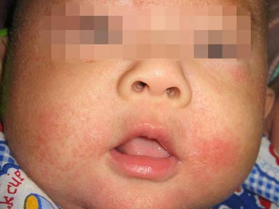 婴儿湿疹的症状表现有什么