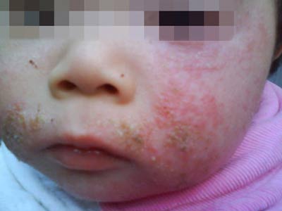 婴儿湿疹什么症状特点