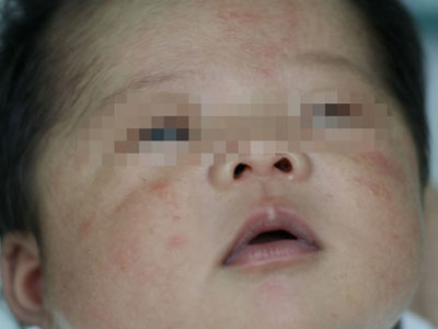 儿童湿疹的一些常见的原因