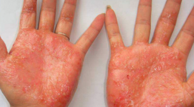 北京大学人民医院皮肤科手癣由于真菌感染手部皮肤引起的一种疾病,即