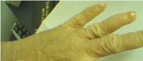 鱼鳞病患者的手部皮肤僵硬的病症