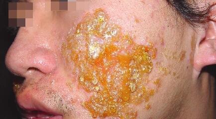 急性湿疹的的症状表现