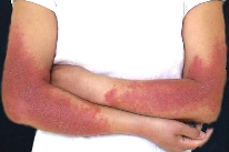 夏季容易引起皮肤过敏的疾病