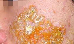 急性湿疹的症状有什么