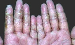 急性夏季湿疹症状有什么