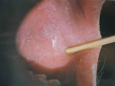 口腔扁平苔癣的治疗方法是什么
