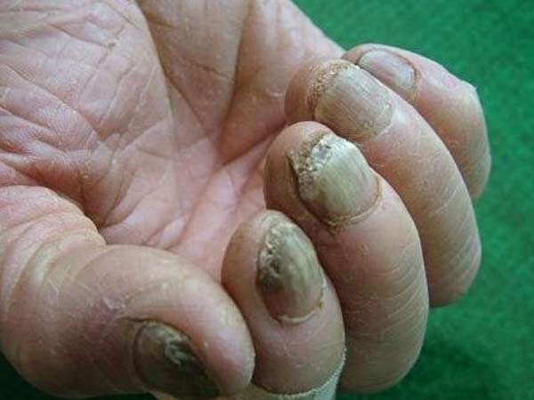 灰指甲患者怎么治