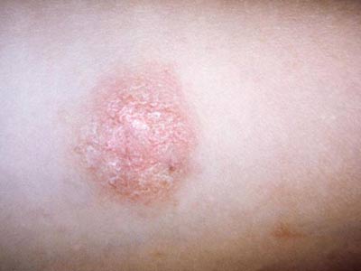 玫瑰糠疹与梅毒有什么不同