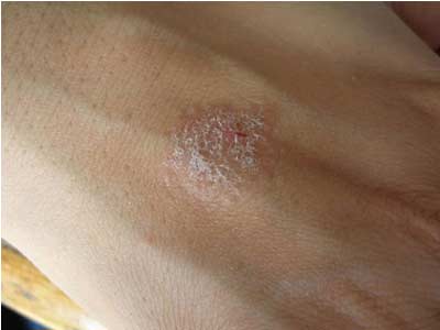 湿疹的预防应需要注意什么