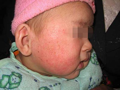 宝宝湿疹症状图片