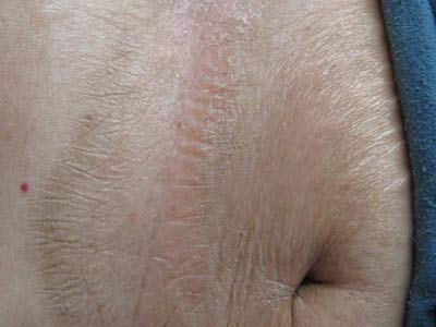 常见的硬皮病是一种主要以皮肤及各编制胶原纤维软化为特征的结缔组织